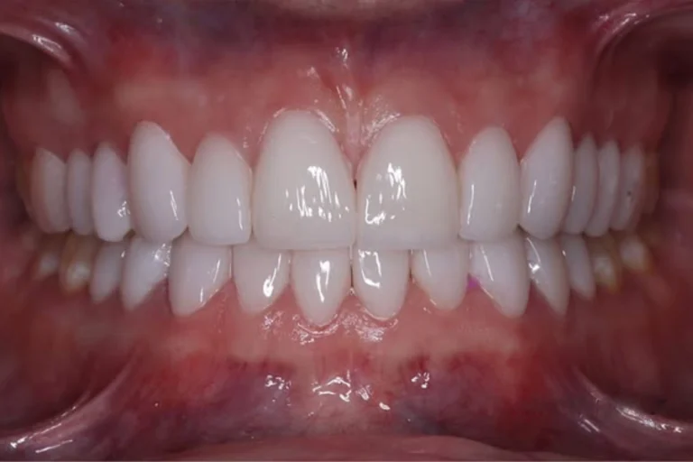 carillas de porcelana medellin