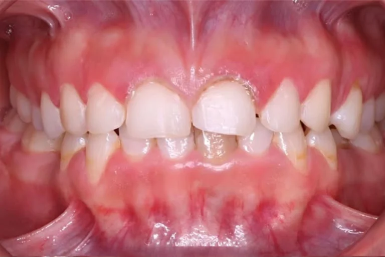 Antes carillas de porcelana en medellin