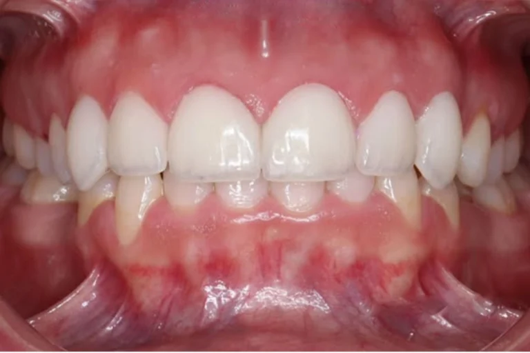 Carillas de porcelna medellín